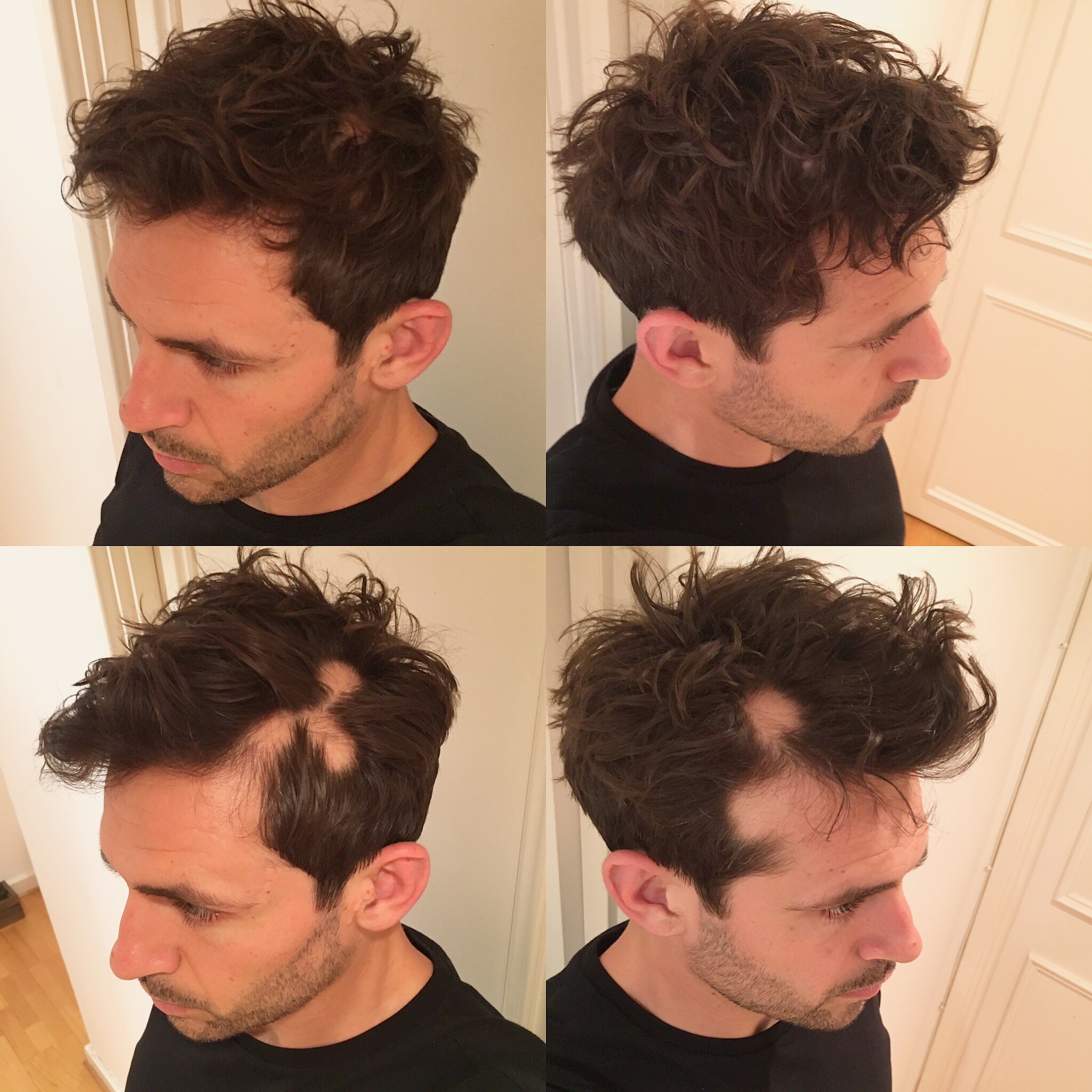 Hair patches before and after arranging hair